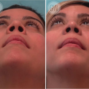 Alar Base Reduction Gallery Rhinoplastyperth