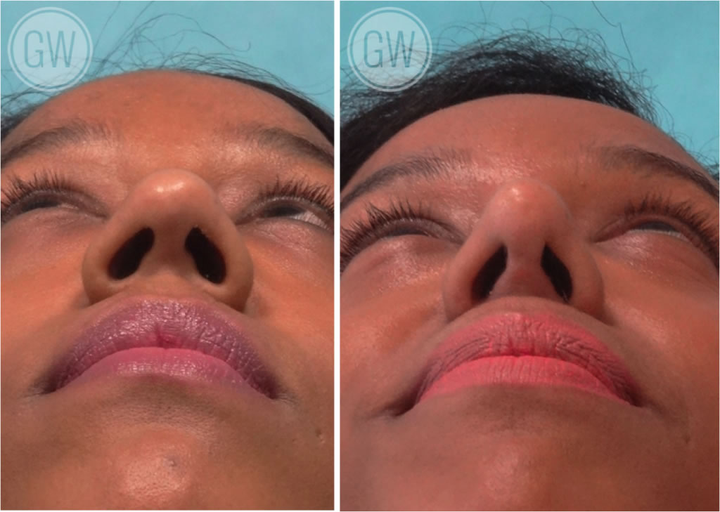 Alar Base Reduction Gallery Rhinoplastyperth