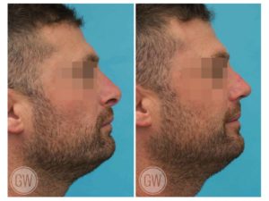 Revision Rhinoplasty + Septoplasty