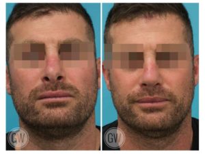 Revision Rhinoplasty + Septoplasty